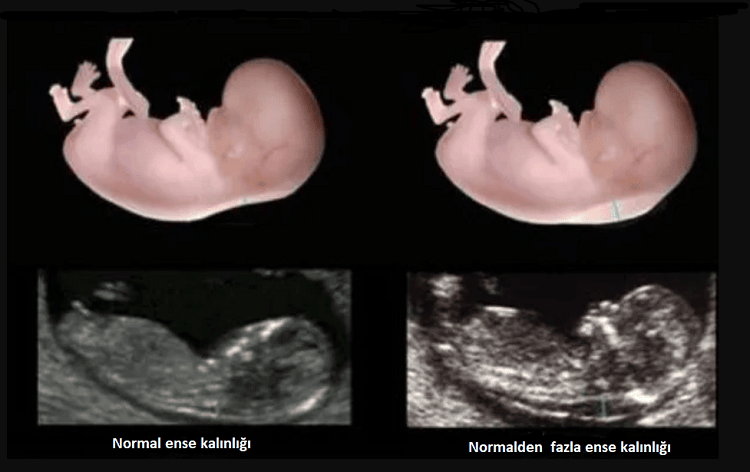 Ense kalınlığı ölçümü ve sınır değerleri (gebelikte).