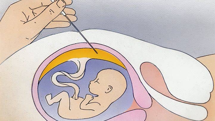 Gebelikte Down sendromu riskleri ve belirtileri