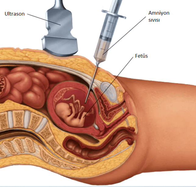 Amniyosentez nedir? Niçin yapılır?