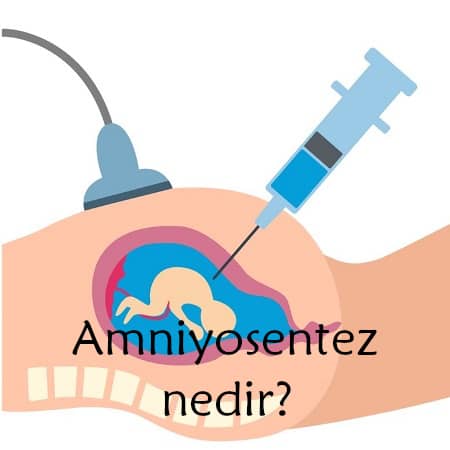 Amniyosentez nedir?