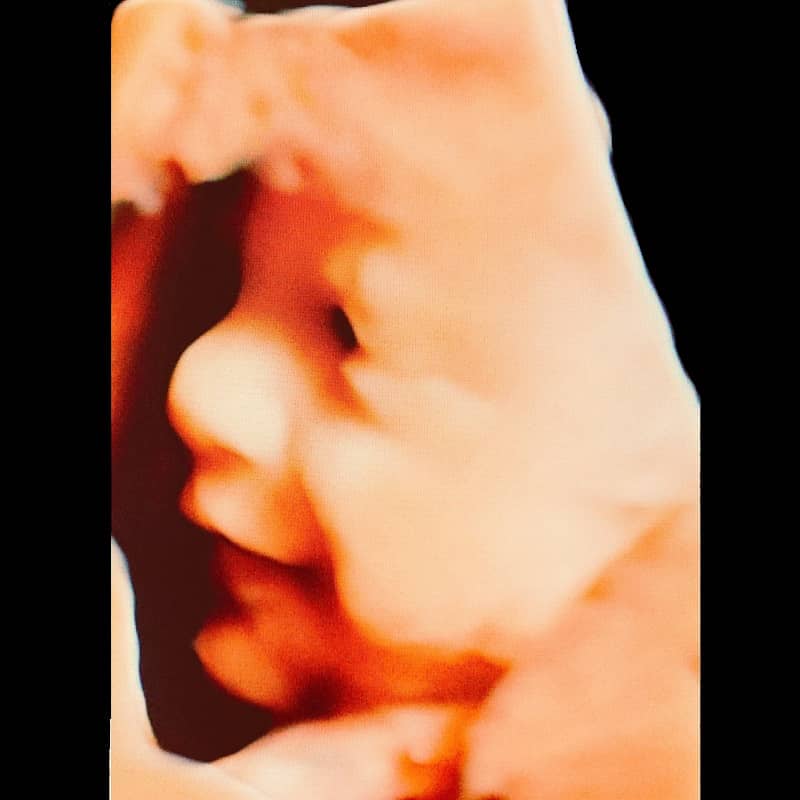 Perinatoloji ayrıntılı ultrason, gebelikte renkli ultrason