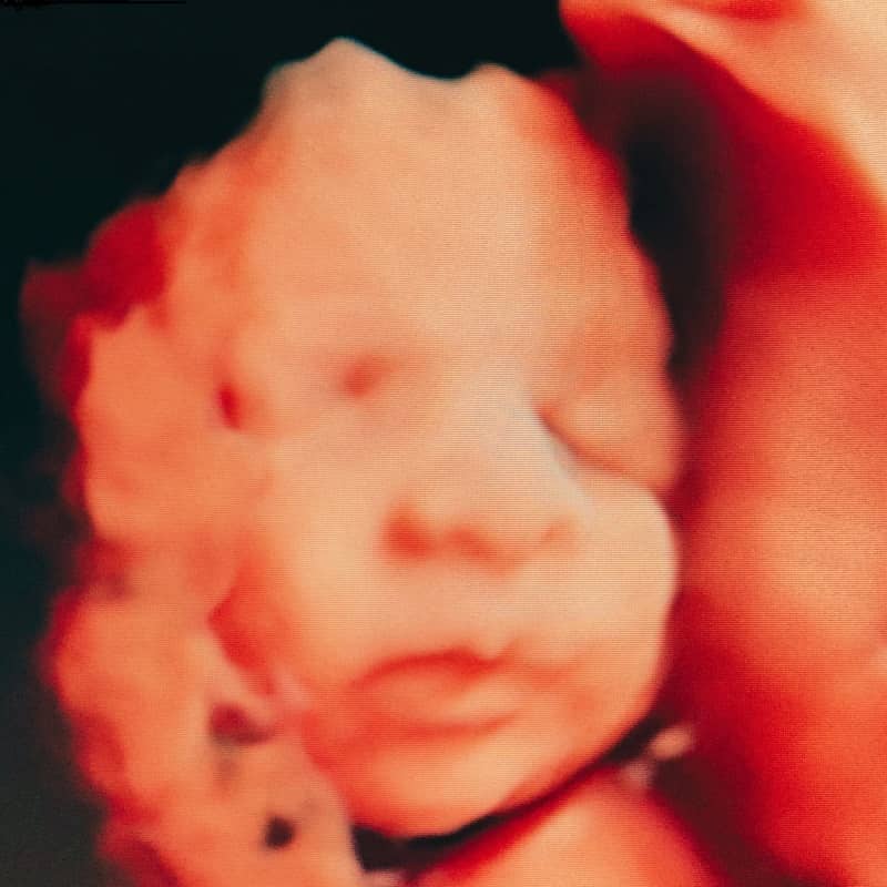 ayrıntılı ultrason ankara, detaylı ultrason perinatoloji