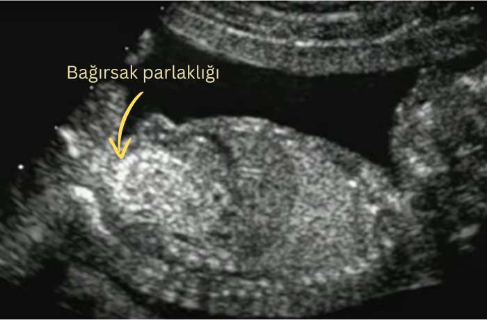 Bağırsak parlaklığı, bebek bağırsağında parlaklık olup doğum yapanlar