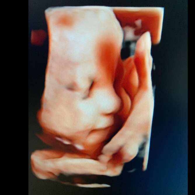 ankara ayrıntılı ultrason öneri, ankara 4 boyutlu ultrason