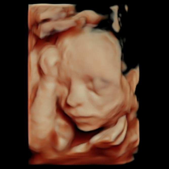 perinatoloji ayrıntılı ultrason, ankara 4 boyutlu ultrason